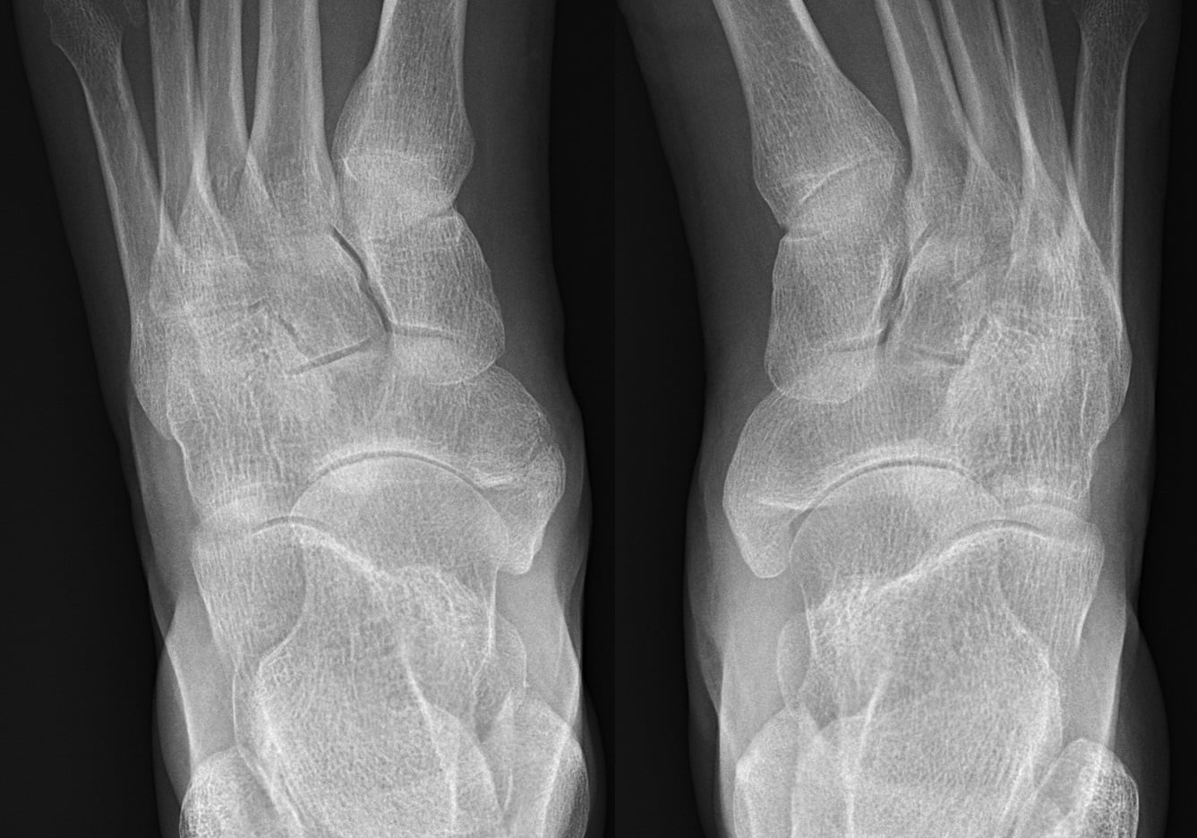 Paired dorsoplantar radiographs comparing a type II accessory navicular with a fused cornuate navicular.