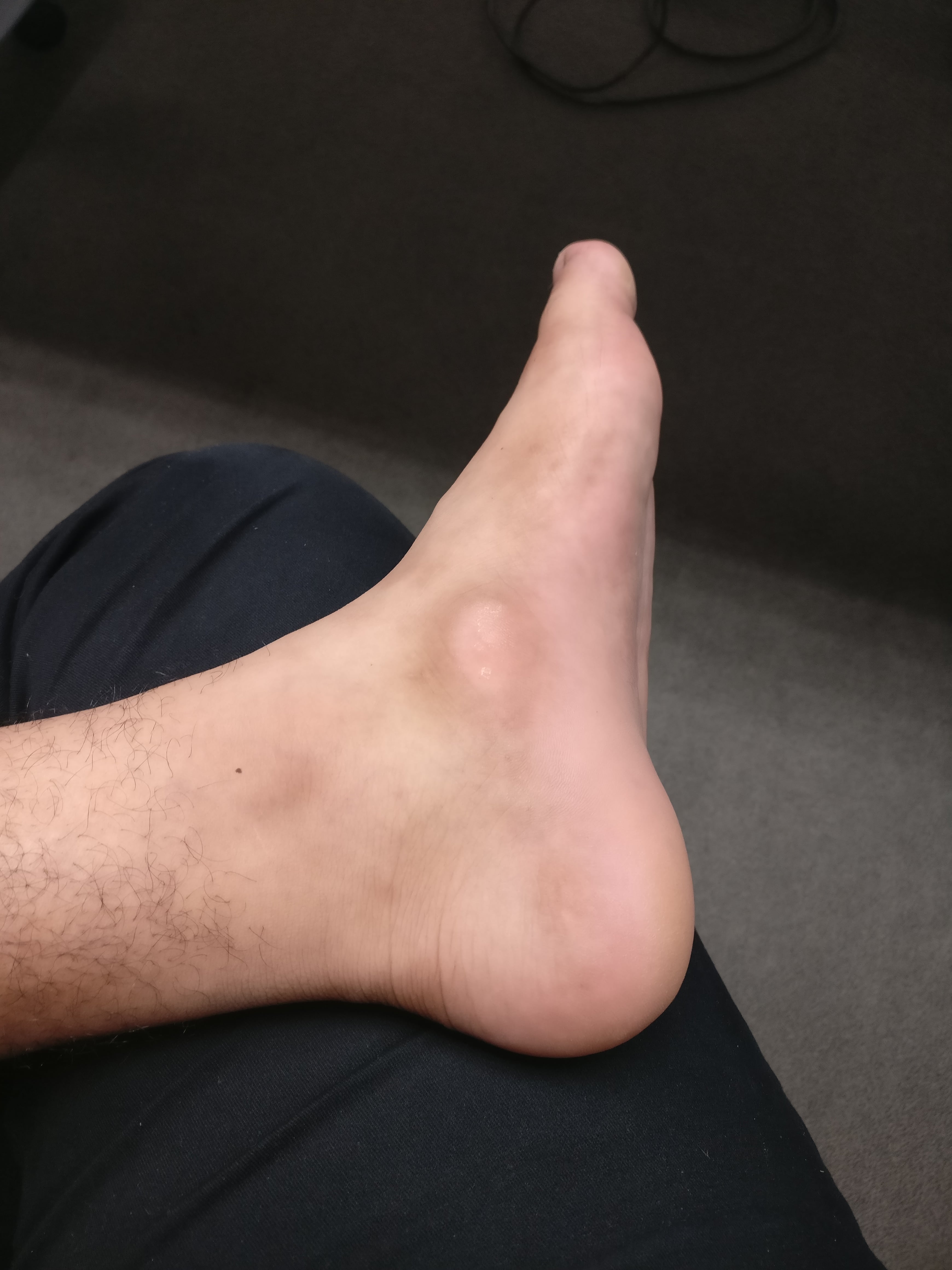 Clinical photograph showing a medial foot prominence at the level of the navicular.