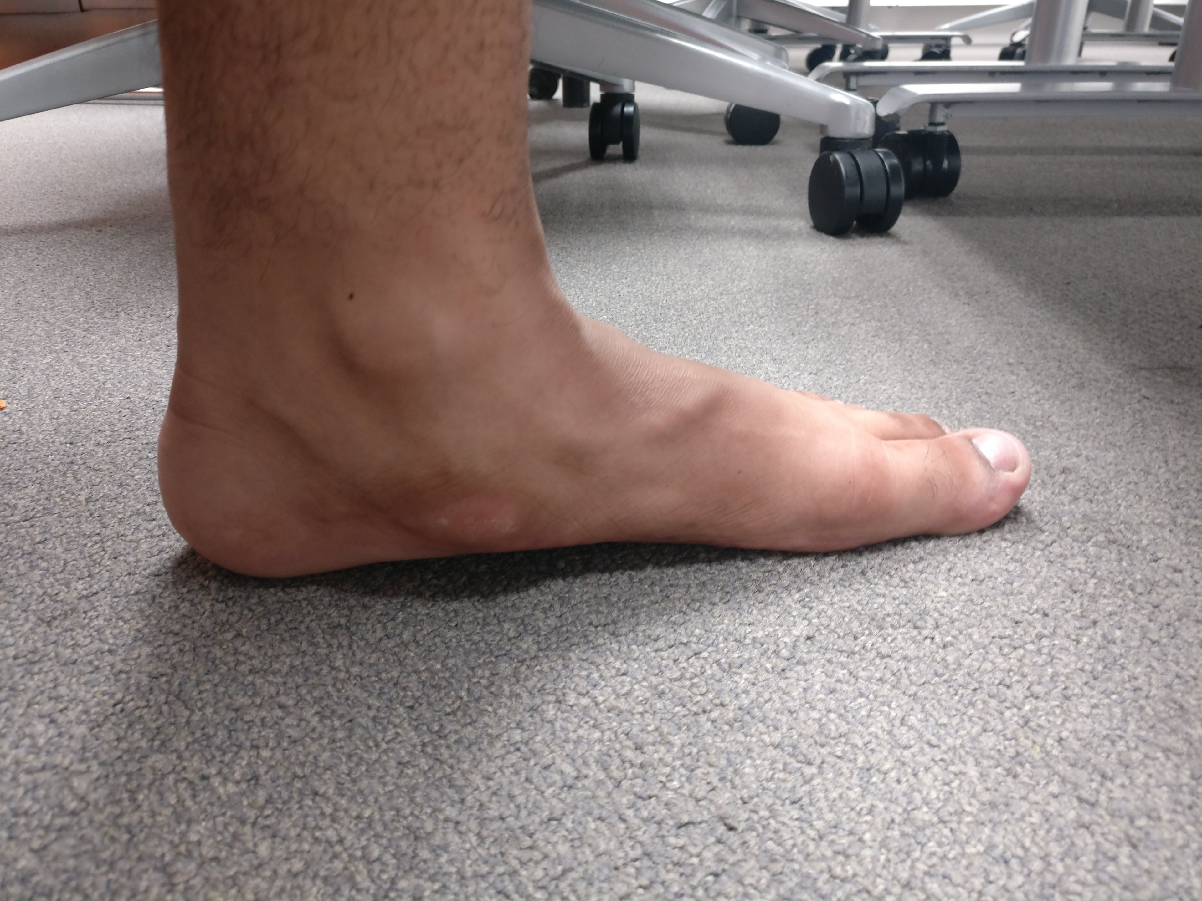 Clinical lateral photograph showing a planovalgus foot with a lowered medial arch.