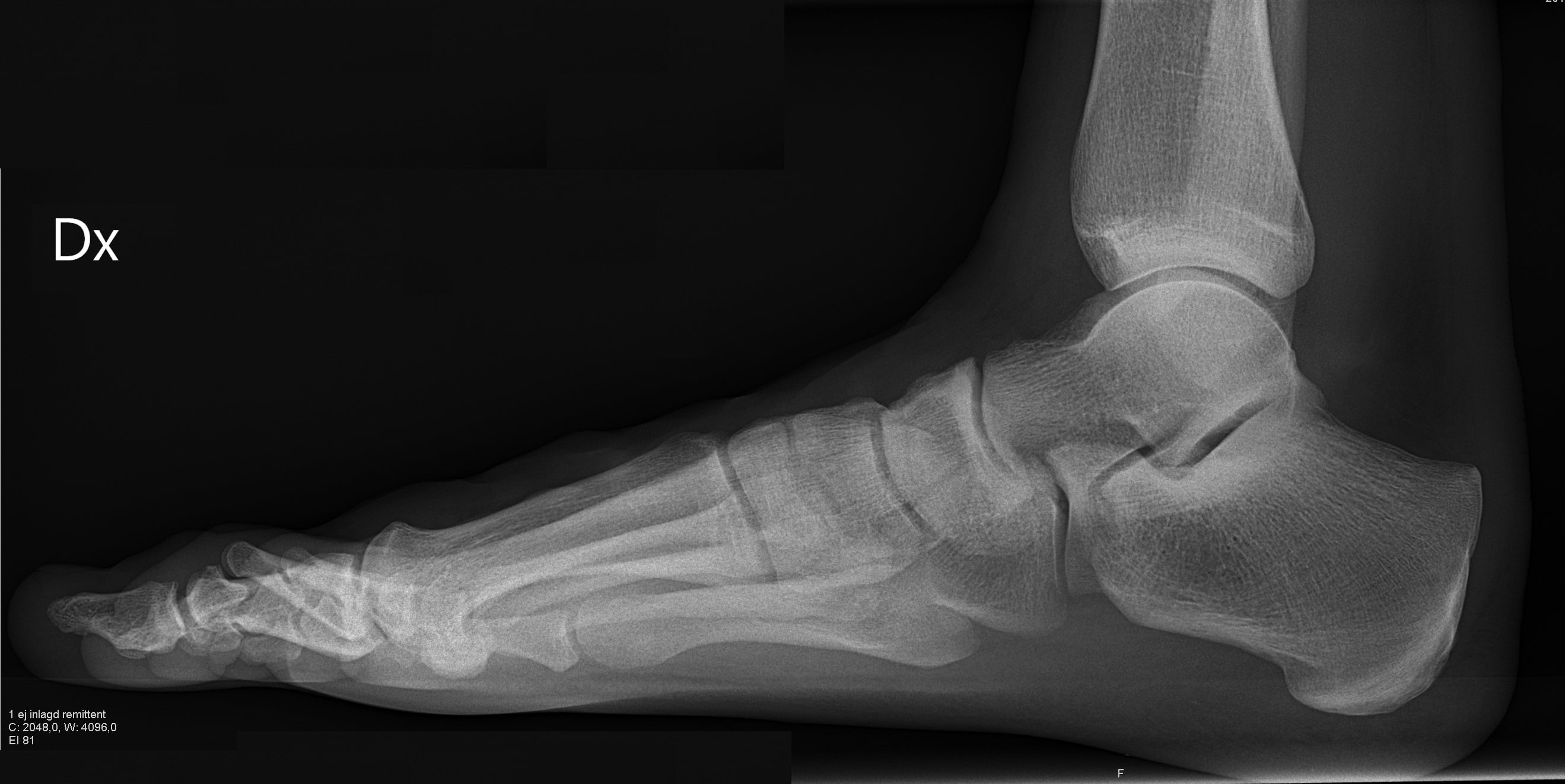 Lateral radiograph of a normal foot with a preserved medial longitudinal arch and normal calcaneal pitch.