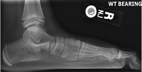 Weight-bearing lateral foot radiograph showing a flattened medial longitudinal arch and reduced calcaneal pitch in pes planus.