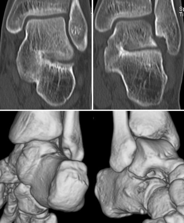 Coronal CT slices and three-dimensional reconstructions showing an osseous talocalcaneal coalition.