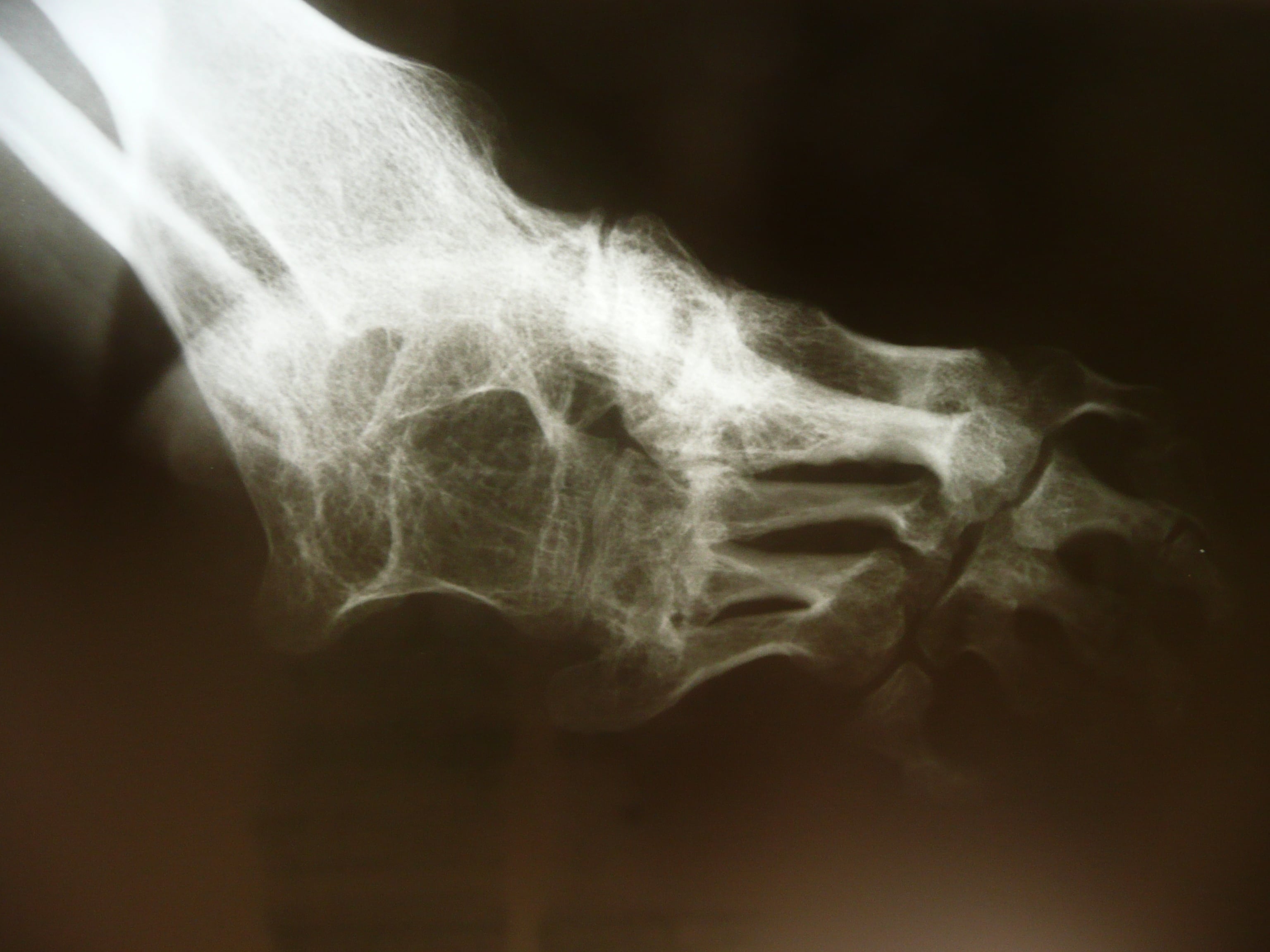Unannotated lateral hindfoot radiograph from a tarsal-coalition teaching series.