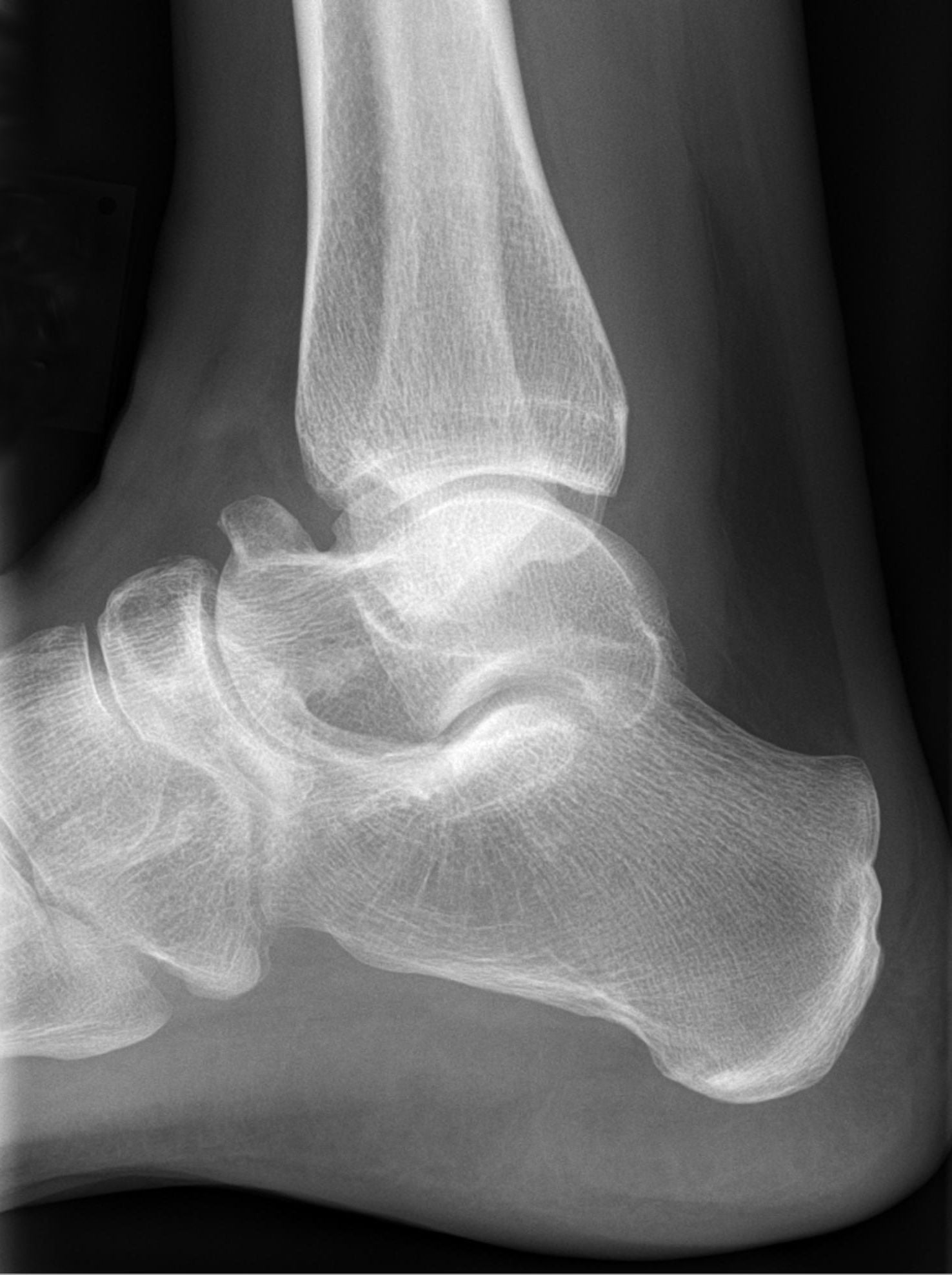 Lateral foot radiograph showing a prominent talar beak, an indirect sign that may accompany talocalcaneal coalition.