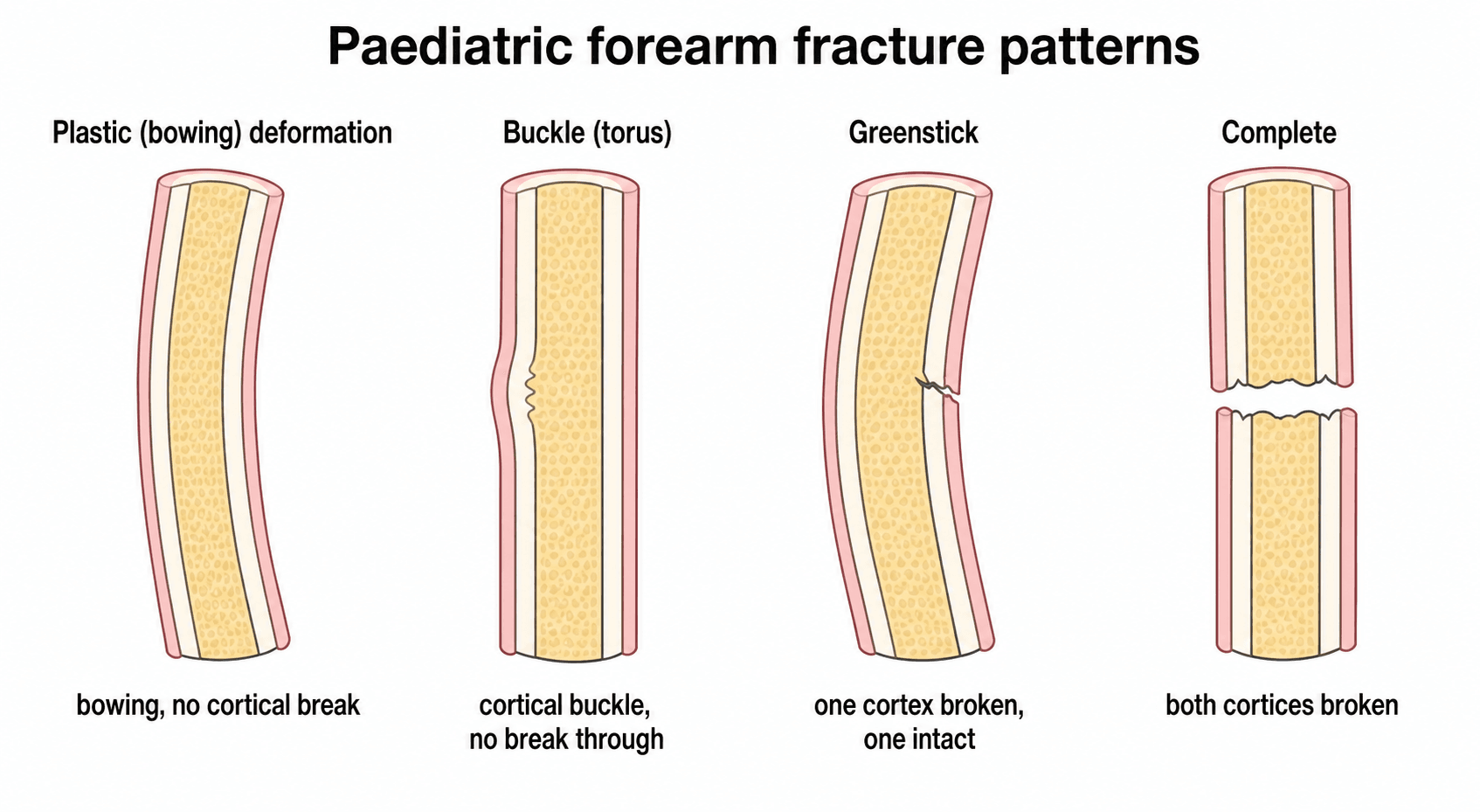 Four-panel schematic of paediatric forearm fracture classification: plastic deformation, buckle/torus, greenstick and complete fracture