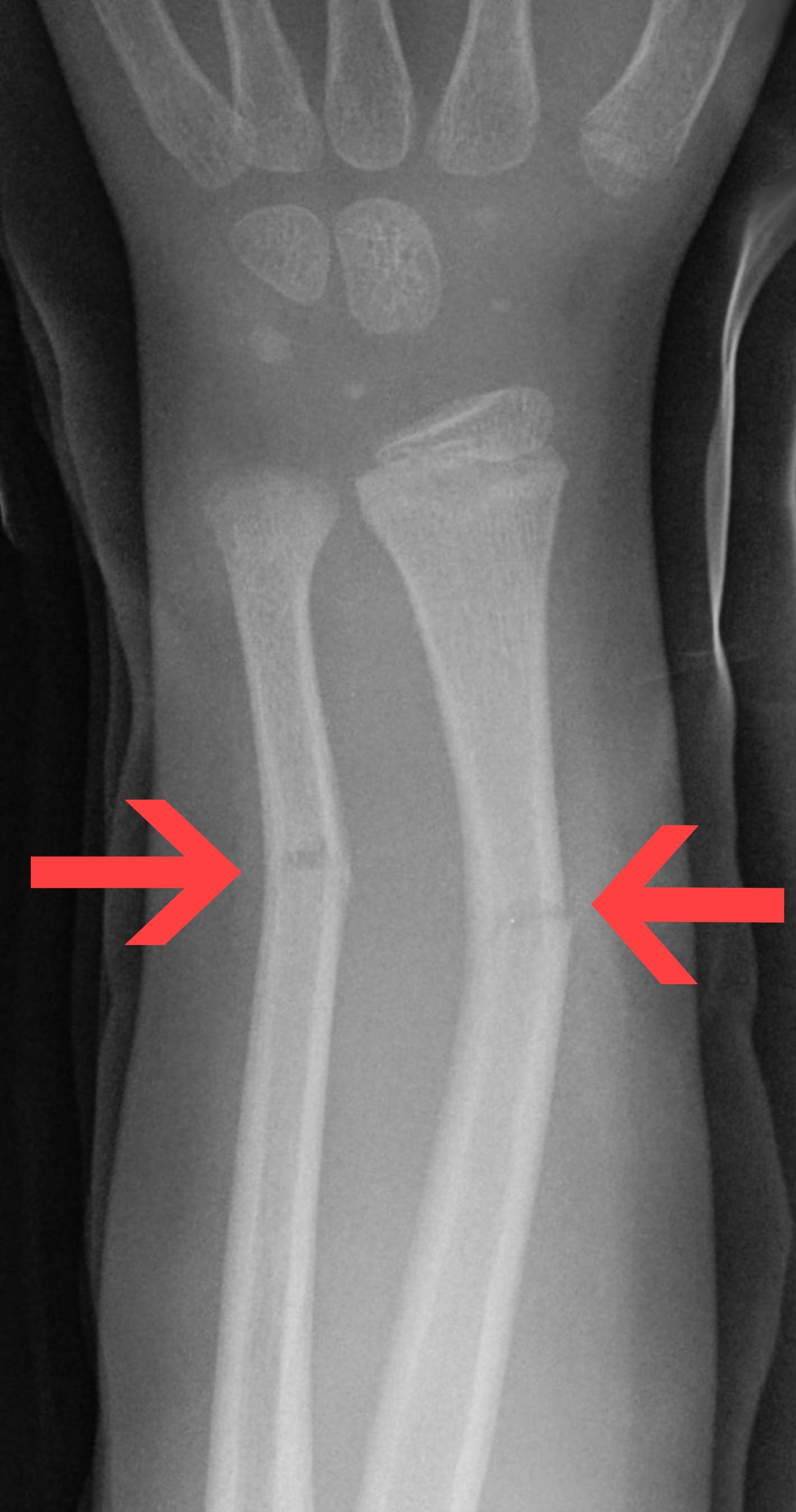 Forearm Fractures - Pediatric - anteroposterior radiograph showing greenstick fractures of radius and ulna.
