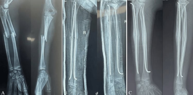 Radiographic sequence of a displaced paediatric both-bone forearm fracture treated with elastic intramedullary nails