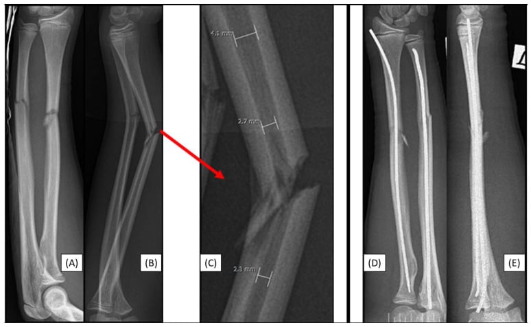 Radiographs showing medullary-canal planning and ESIN fixation of a paediatric both-bone forearm fracture