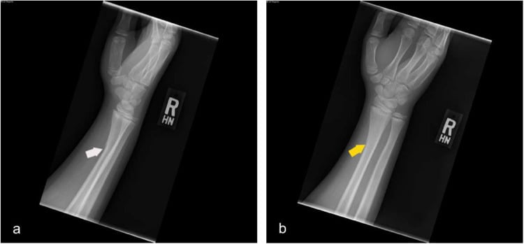 Lateral and oblique paediatric wrist radiographs showing cortical buckle and greenstick patterns