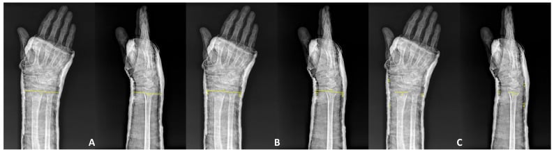 Radiographic schematic showing Cast Index, Gap Index and Three-Point Index measurements