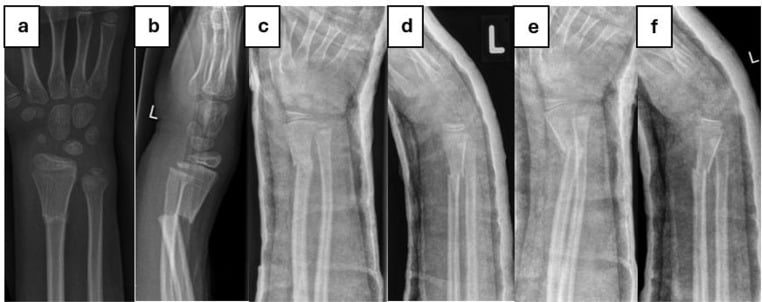 Serial AP and lateral radiographs showing secondary displacement of a paediatric diametaphyseal radius fracture in a cast