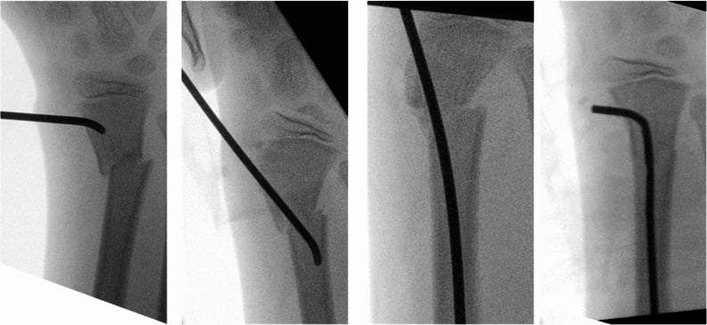 Intraoperative fluoroscopic views of modified retrograde ESIN for a paediatric distal radius fracture