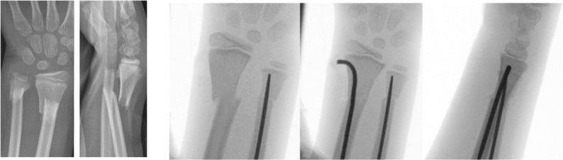 Preoperative and intraoperative radiographs of paediatric distal forearm fracture treated with two elastic nails