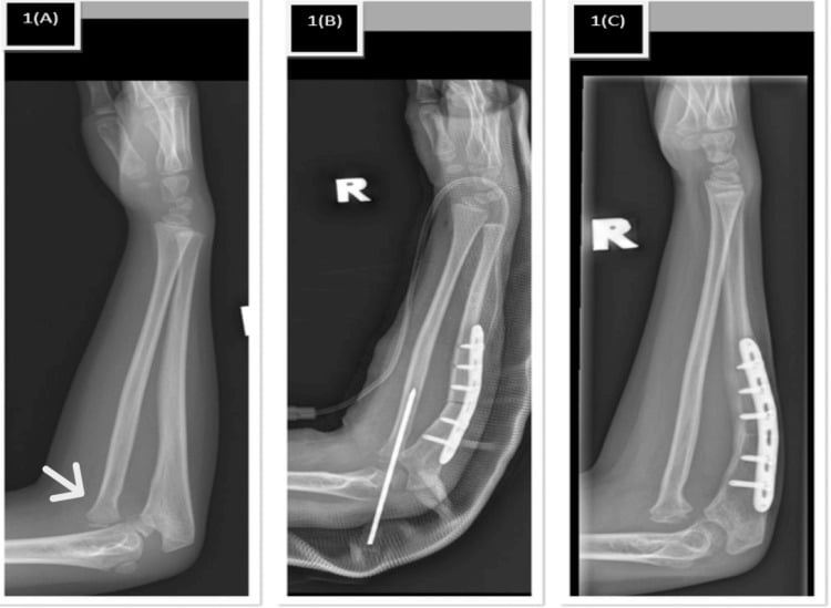 Serial paediatric radiographs showing Bado type I Monteggia lesion with ulnar plastic deformation and radial-head redislocation