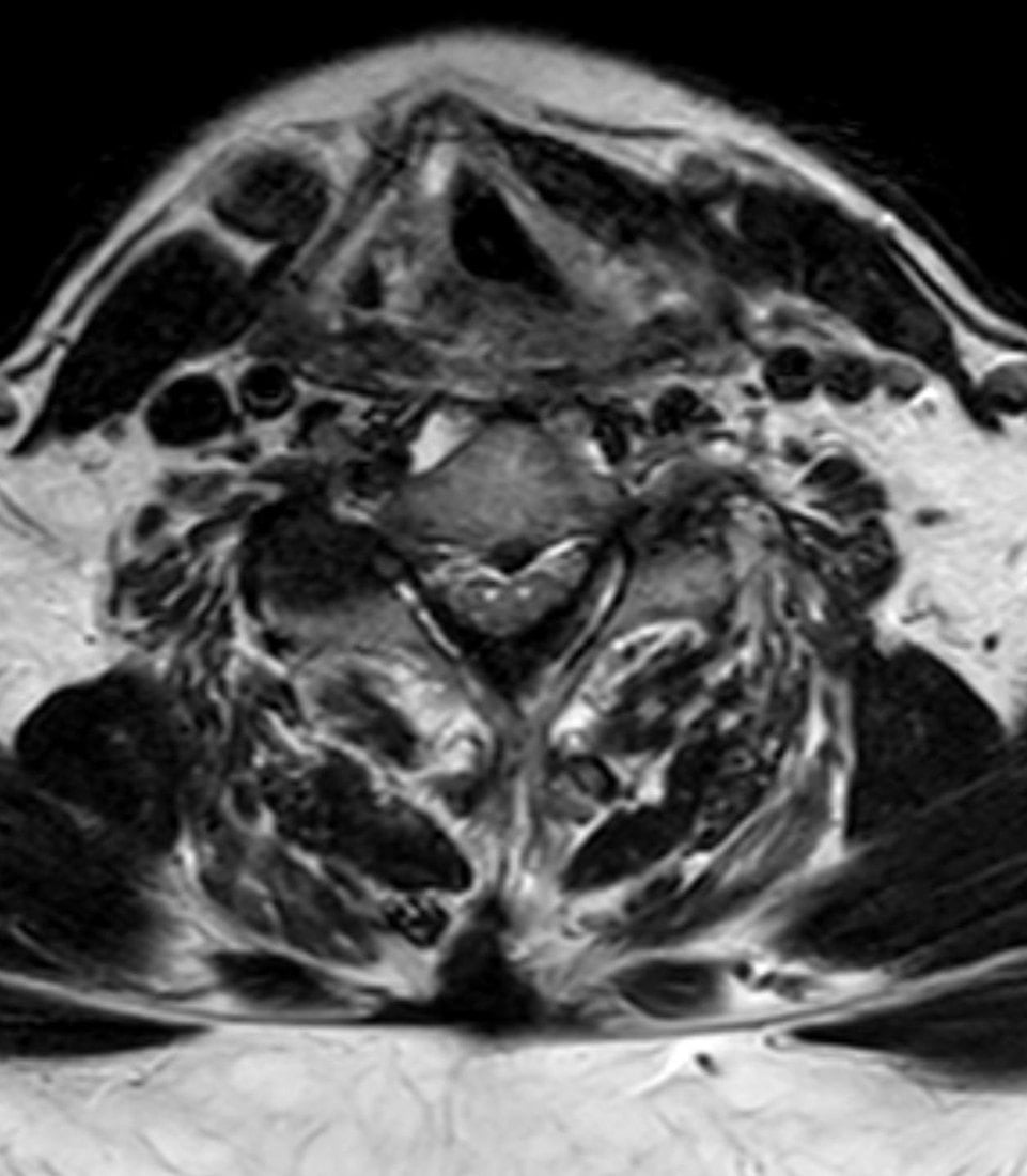 Axial T2 cervical MRI showing symmetric anterior cord hyperintensity (owl-eyes / snake-eyes sign) of spinal cord injury