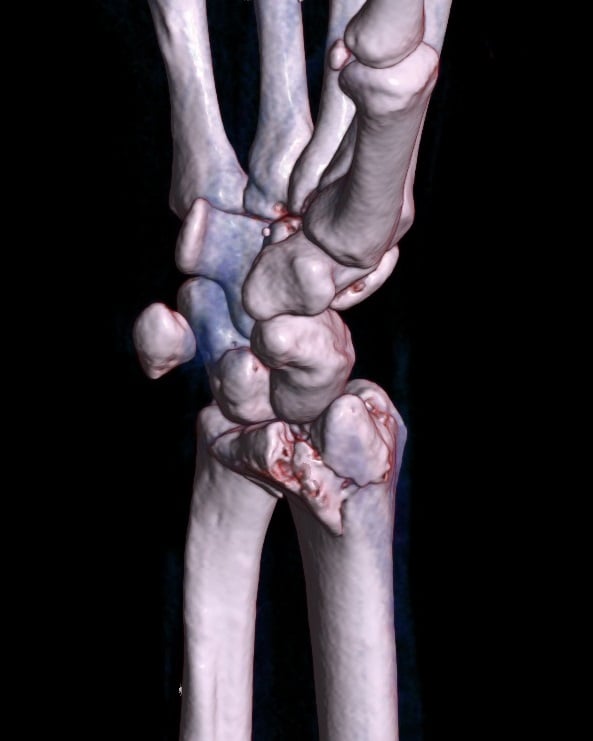 Volume-rendered 3D CT of a comminuted intra-articular distal radius fracture of the right wrist.