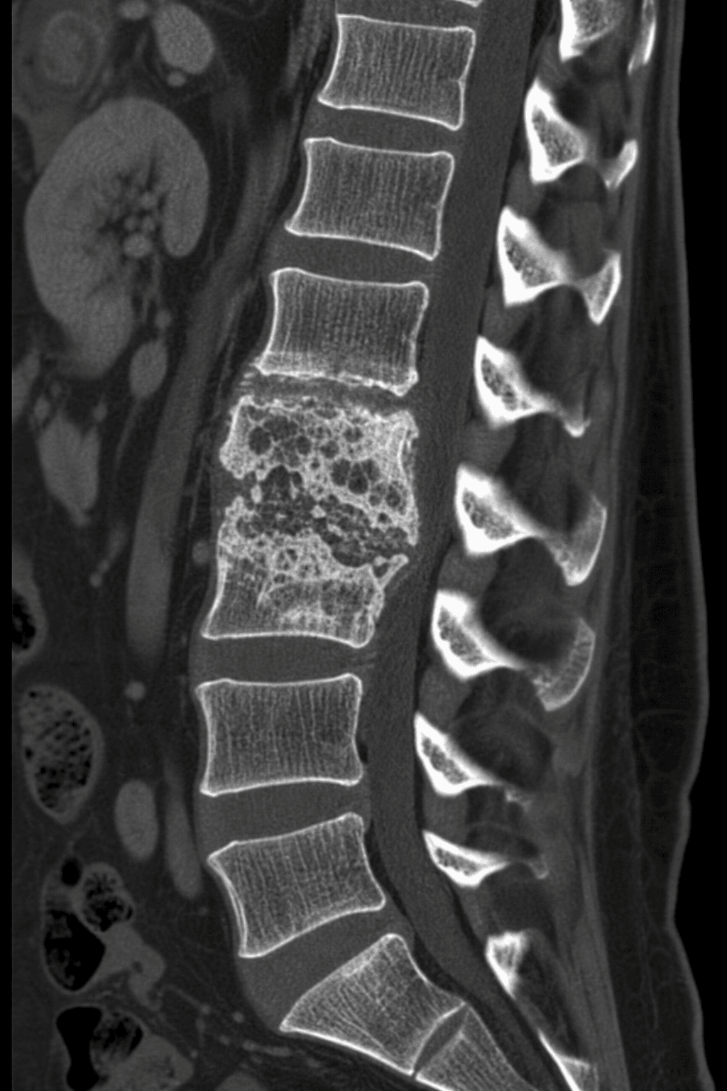 spinal osteomyelitis vertebral destruction CT