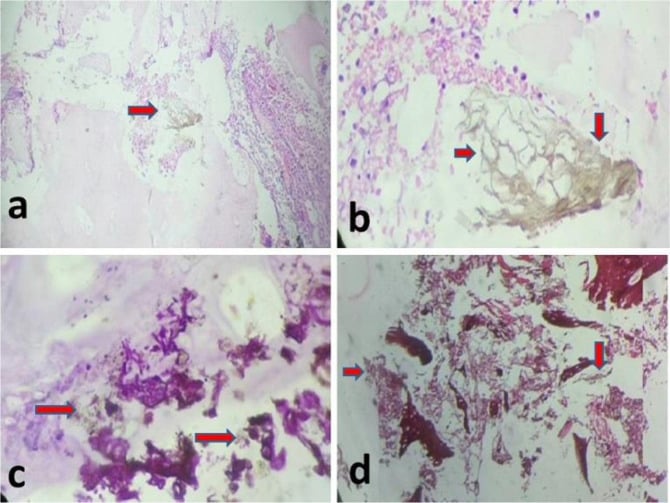 Bone histology panels showing narrow branching Aspergillus hyphae on H&E, PAS and GMS stains.