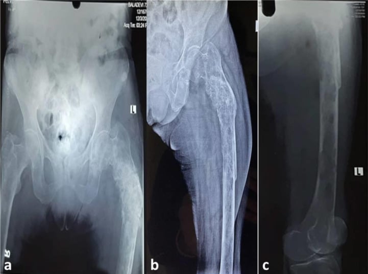 Pelvis and femur radiographs showing extensive permeative osteolysis, cortical breach and proximal femoral deformity.