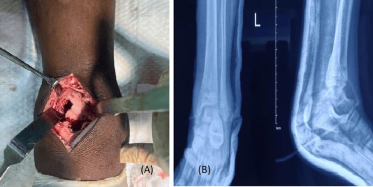 Operative distal tibial cortical window beside postoperative ankle radiographs.