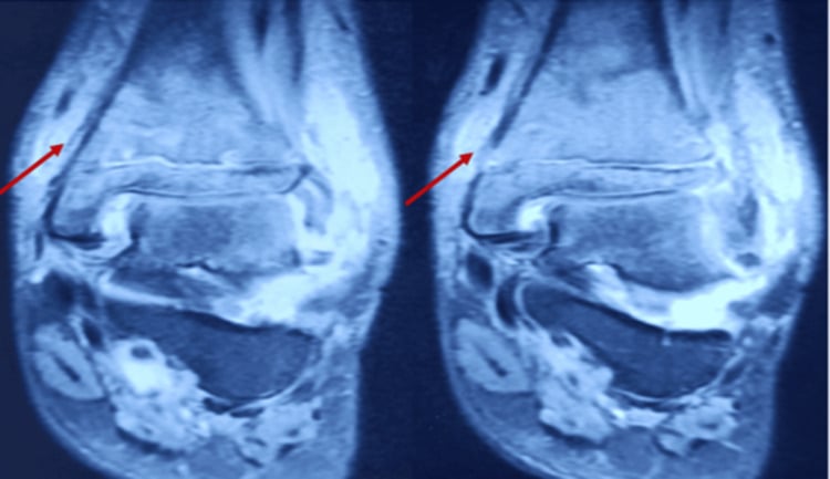 Coronal T2-weighted ankle MRI showing distal tibial marrow and soft-tissue signal abnormality.