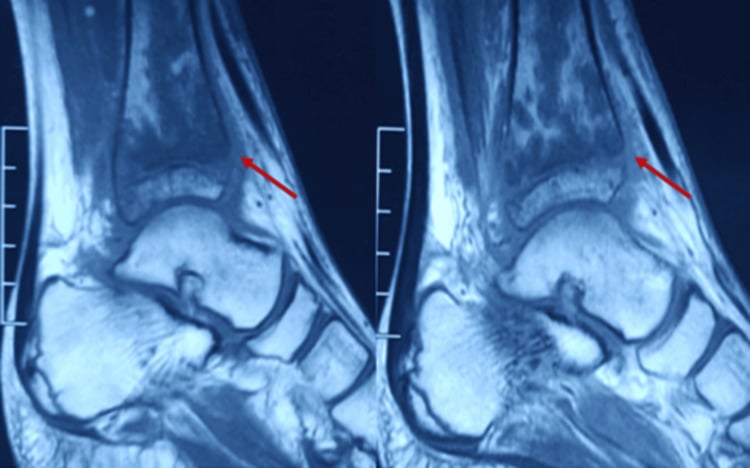 Sagittal ankle MRI showing distal tibial marrow signal abnormality in Candida osteomyelitis.