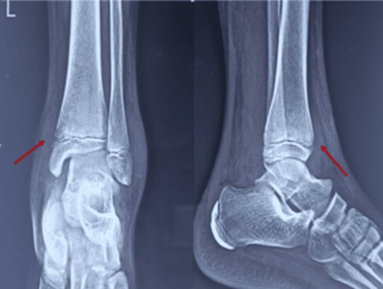 AP and lateral ankle radiographs showing regional osteopenia and distal tibial physeal-margin irregularity in Candida osteomyelitis.