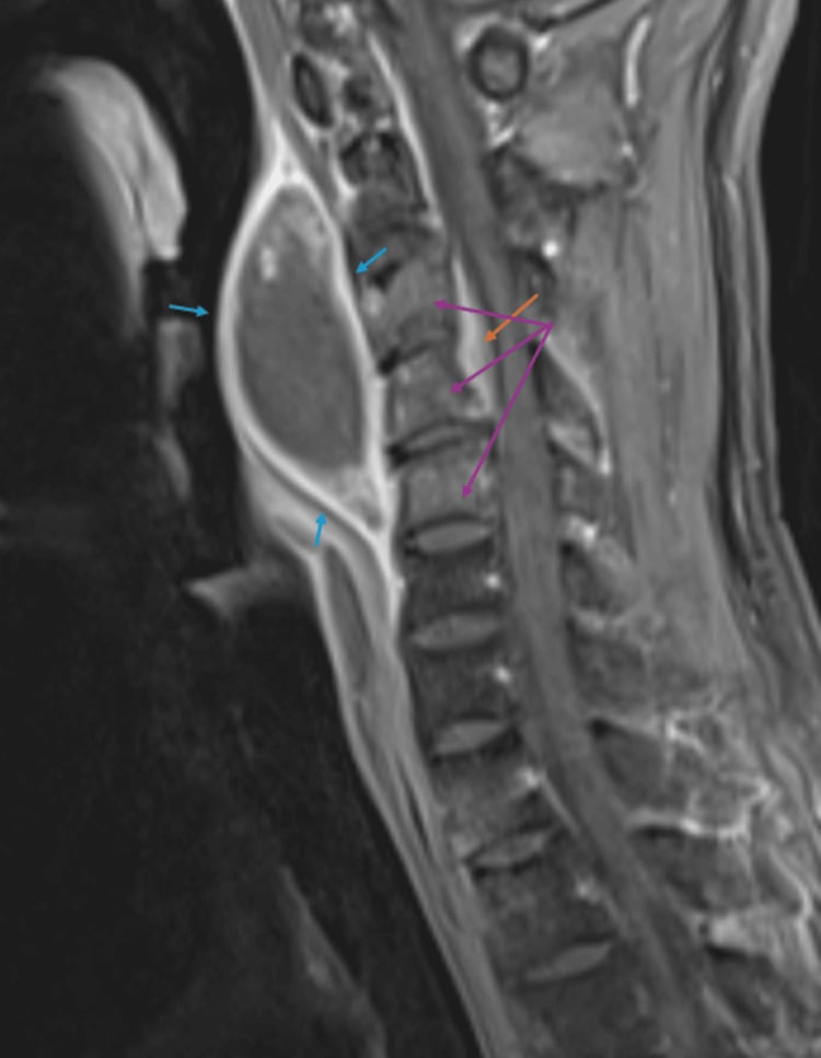 Sagittal contrast-enhanced cervical MRI showing C3 to C5 osteomyelitis, epidural inflammation and a prevertebral abscess.