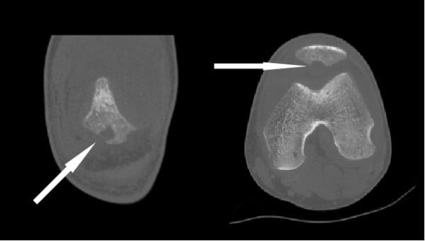 Coronal and axial knee CT showing focal osteolysis of the inferior patella.