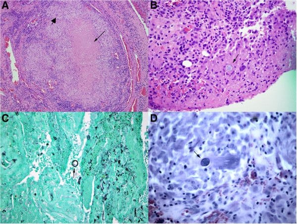 Histology panels showing granulomatous synovium and Coccidioides spherules.