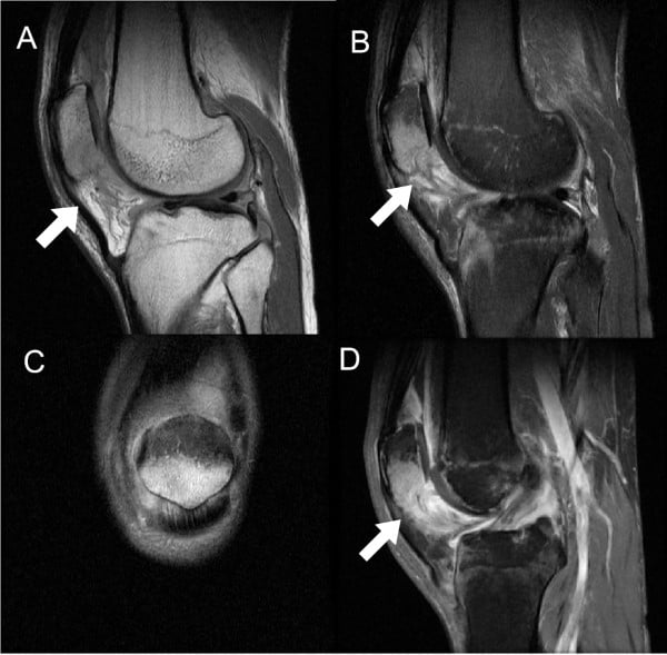 Multisequence knee MRI showing inferior-patellar osteolysis, synovitis and adjacent marrow oedema.