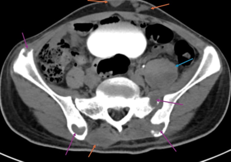 Axial pelvic CT showing destructive bilateral iliac and sacral lesions with left iliopsoas enlargement.