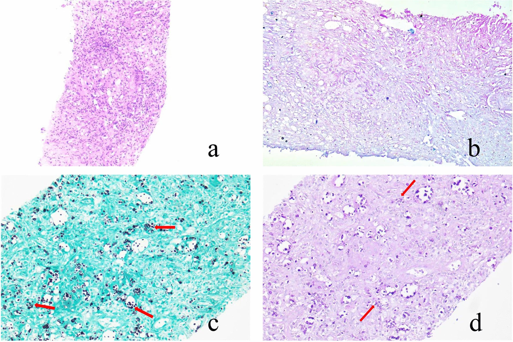 Bone biopsy panels showing granulomatous inflammation and numerous cryptococcal yeast on GMS and PAS stains.
