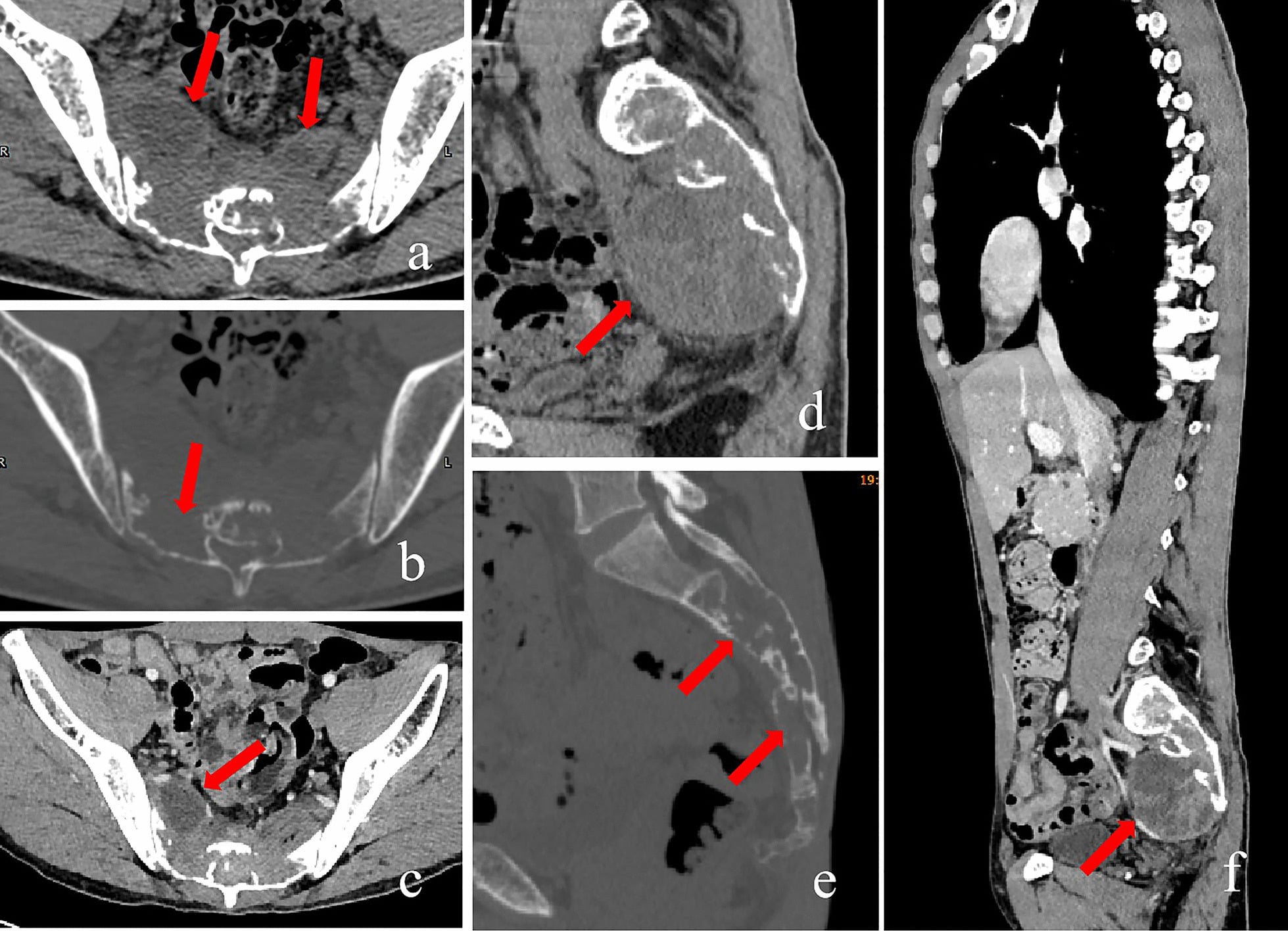 Multiplanar CT showing sacral osteolysis and surrounding low-density collections in cryptococcal osteomyelitis.