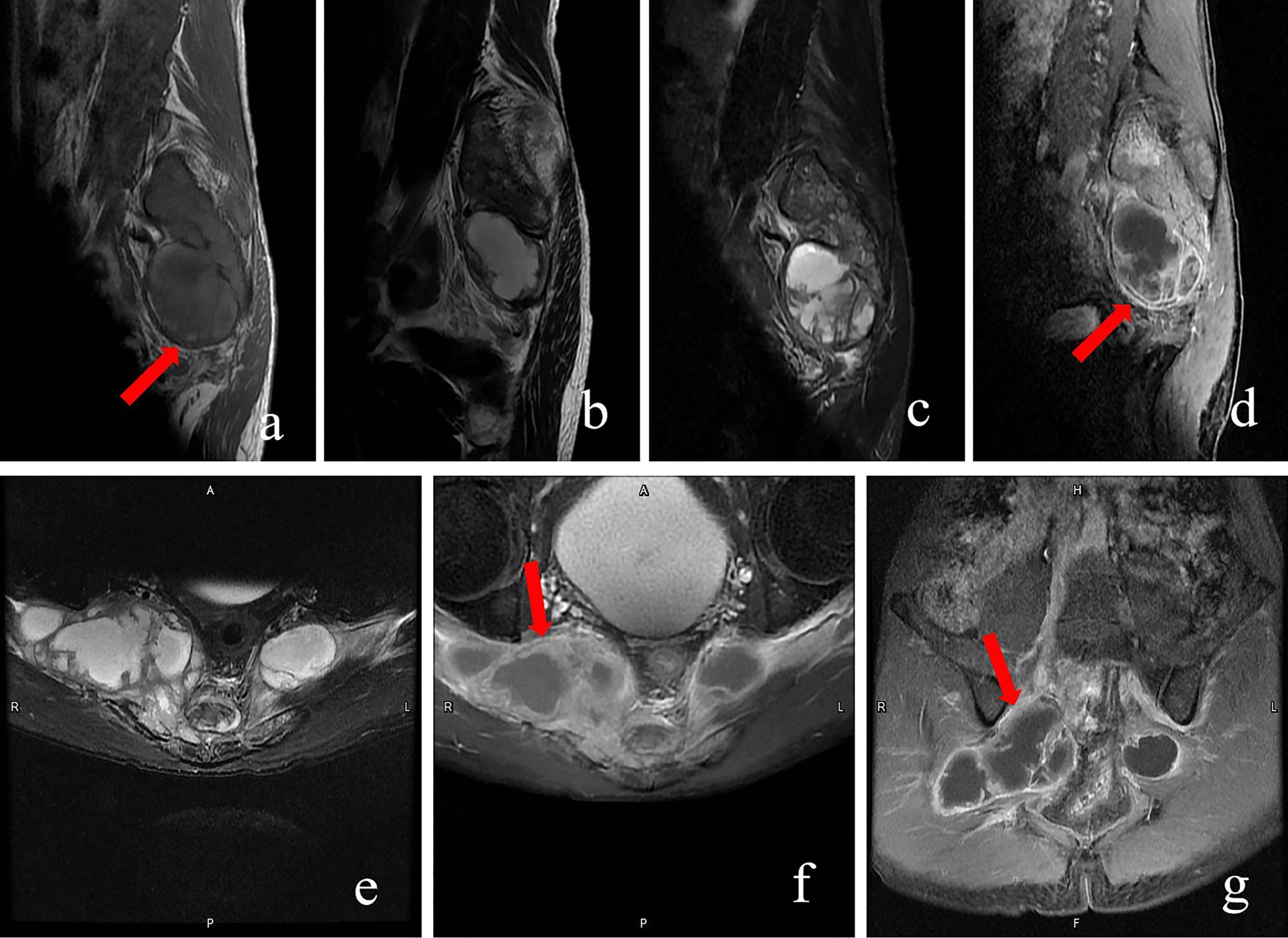 Multisequence sacral MRI showing marrow replacement and multiloculated presacral and pelvic collections.