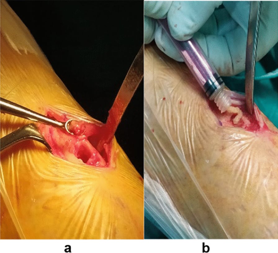 Operative photographs showing tibial lesion debridement and subsequent allograft placement.