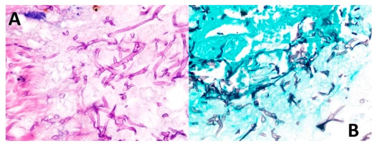 H&E and GMS histology panels showing broad ribbon-like pauci-septate Mucorales hyphae.