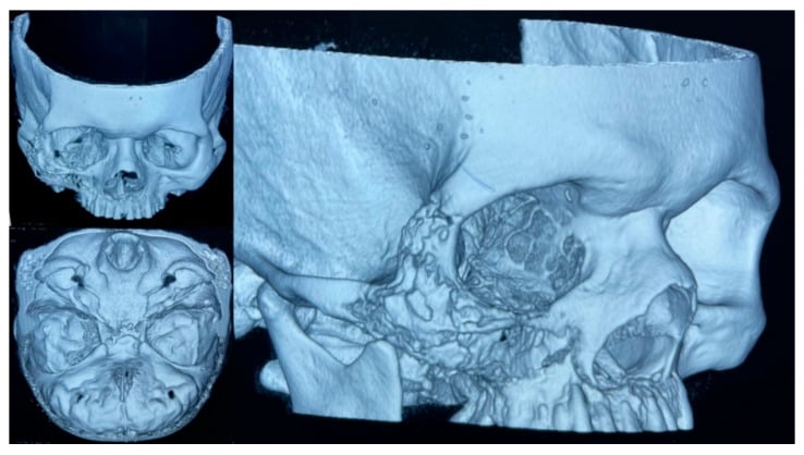 Three-dimensional craniofacial CT reconstruction showing destructive maxillary and orbital-floor osteomyelitis.