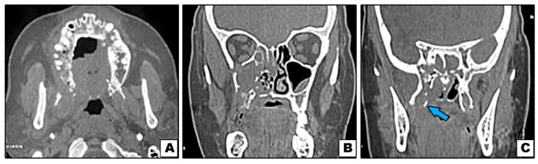 Axial and coronal CT images showing destructive maxillary osteomyelitis and pterygoid-plate involvement.