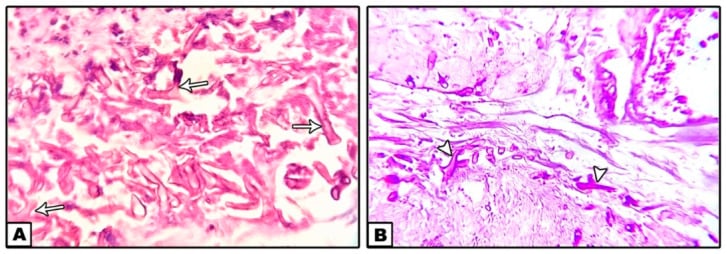 H&E and PAS histology panels showing non-septate right-angle branching Mucorales hyphae in necrotic tissue.