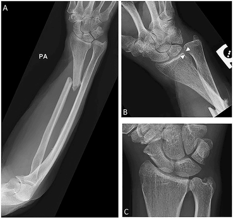 PA forearm and wrist radiographs showing a Galeazzi fracture-dislocation