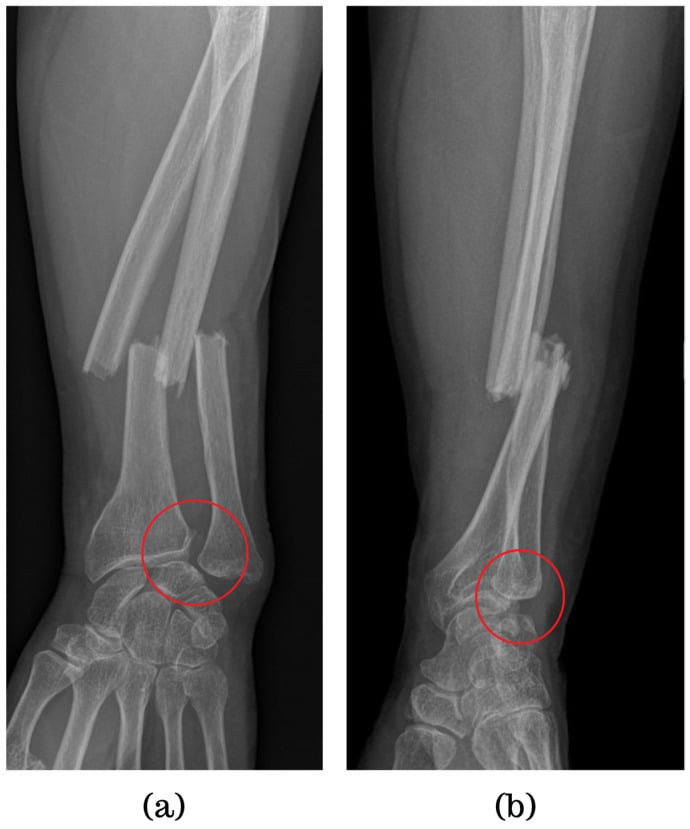 Forearm radiographs showing distal radial fracture with DRUJ dislocation