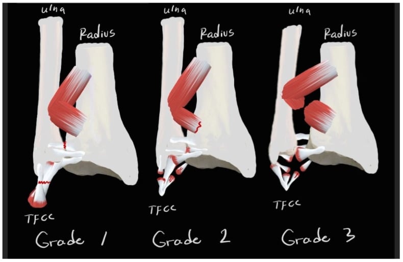 Anatomical diagram of DRUJ injury classification and TFCC injury grades