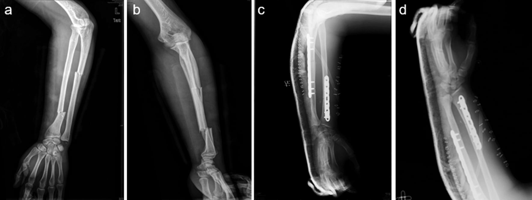 Preoperative and postoperative radiographs of Galeazzi fracture ORIF plating