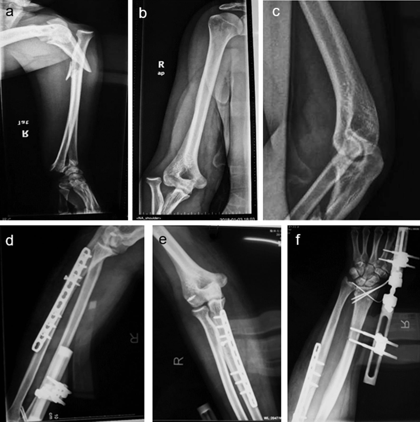 Preoperative and postoperative radiographs of comminuted Galeazzi fracture plating