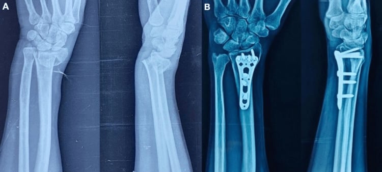 Preoperative and 12-month postoperative radiographs of Galeazzi fracture ORIF