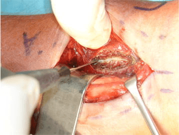 Intraoperative photograph of pronator quadratus during volar approach