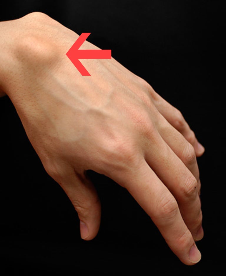 Clinical photograph of a dorsal wrist ganglion cyst - a firm, smooth swelling on the back of the hand near the wrist.