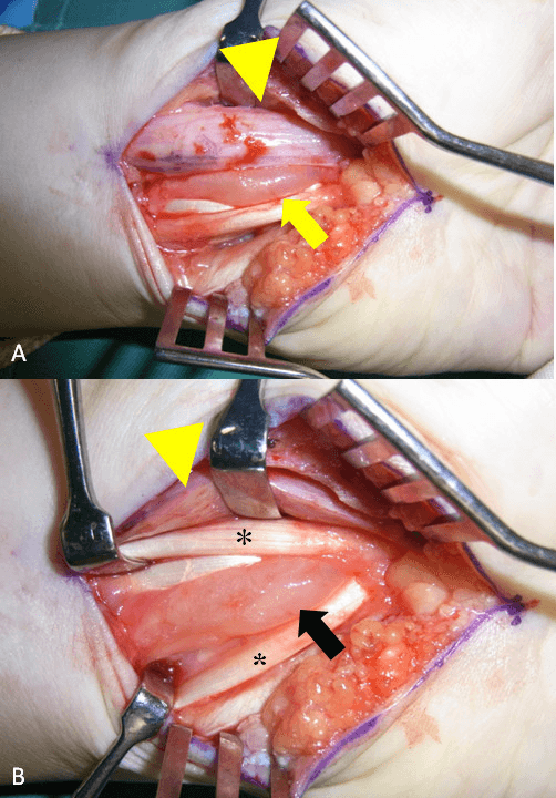 Intraoperative view of ganglion cyst compressing median nerve