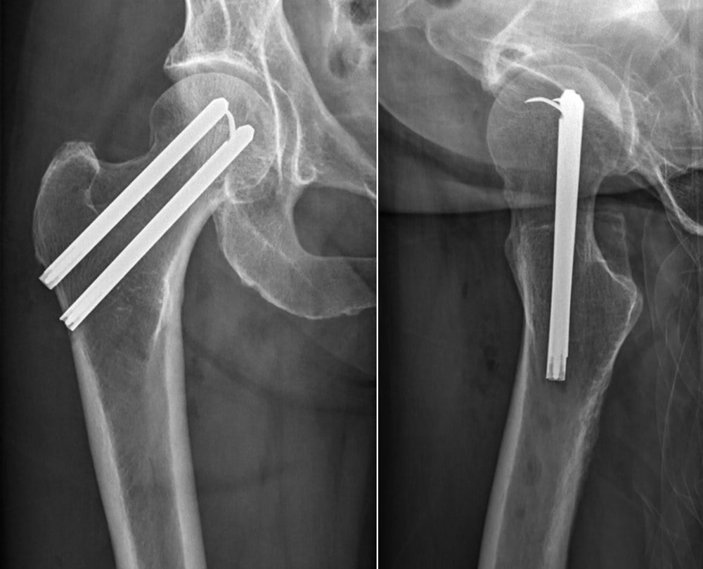 AP and lateral hip radiographs showing a femoral neck fracture fixed with two parallel cannulated screws/pins.